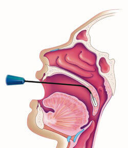 Coblation Medical Diagram