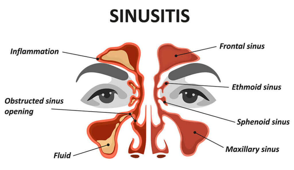 Sinusitis illustration